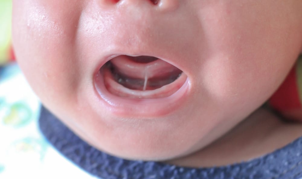 Laser Frenectomy in Cedar Hill and Midlothian