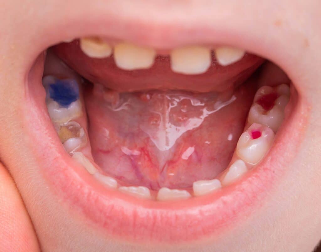 Dental team member brushing a baby's teeth while her mother holds her during a first visit